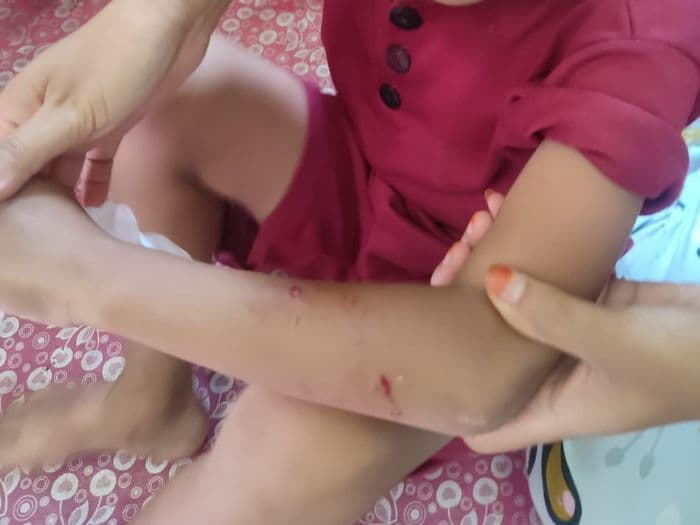 Kasus Anjing Rabies Gigit 7 Warga Tanah Jawa, Korban Dalam Pemantauan