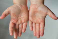 Dinkes Medan Temukan Flu Singapura, Masuk Golongan ISPA